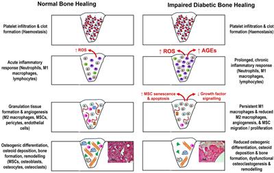 Role of oxidative stress in impaired type II diabetic bone repair: scope for antioxidant therapy intervention?